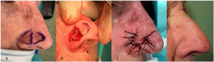 Diseño, realización y postoperatorio del colgajo en muleta taurina en ala nasal derecha. A: Diseño del colgajo. B: Extirpación de la lesión de forma triangular e incisión del colgajo. C: Rotación del colgajo y sutura. D: Resultado final al mes de seguimiento.