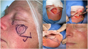 Diseño, realización y postoperatorio del colgajo nautilus en una lesión subpalpebral izquierda juntamente con un diseño de un huso simple para otra lesión medial a esta de menor tamaño. A: Diseño del colgajo. B: Extirpación de la lesión creando un defecto quirúrgico triangular. C: Rotación de los 2 colgajos triangulares en sentido opuesto. D: Sutura final de los colgajos. E: Resultado final a los 3 meses de seguimiento.