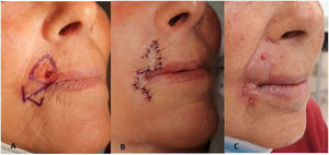 Colgajo nautilus empleado en la reconstrucción de un defecto quirúrgico en labio superior tras la extirpación de un carcinoma basocelular infiltrante. A: diseño del colgajo convirtiendo el defecto circular en triangular. B: Postoperatorio inmediato, sutura con prolene 4.0. C: Resultado estético tras la retirada de puntos. La morfología del tumor obliga al diseño del triángulo con la base enfrente del borde libre del labio superior. Sin embargo, la dirección del vector de tensión es el mismo por lo que no tira del borde libre. La máxima tensión en este caso se genera perpendicular al borde libre, que es el adecuado para evitar retracción. Por eso la cicatriz resultante de la sutura del colgajo se adapta perfectamente al contorno de la zona peribucal del paciente sin deformarlo.