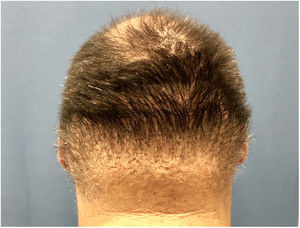 Lipedematous alopecia in the occipital area.