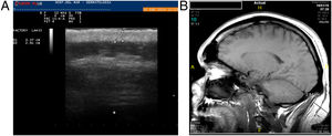 (A) Ultrasounds image of the occipital area with a 2.91cm scalp thickness, (B) magnetic resonance image shows an important difference between vertex and occipital scalp thickness.