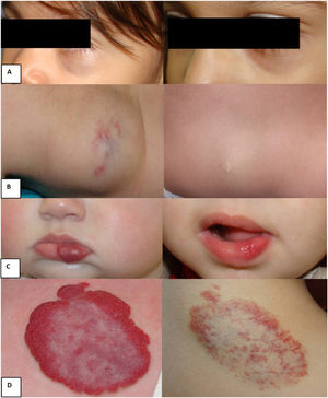 Ejemplos de respuesta al tratamiento con nadolol: A) Hemangioma focal profundo en el párpado inferior izquierdo, edad inicio nadolol: 24 meses, edad fin nadolol: 43 meses. Buena respuesta. B) Hemangioma dorsal focal profundo, edad inicio nadolol: 40 meses, edad fin nadolol: 48 meses. Buena respuesta. C) Hemangioma focal superficial labio inferior, edad inicio nadolol: 11 meses, edad fin nadolol: 27 meses. Buena respuesta. D) Hemangioma escapular focal mixto, edad inicio nadolol: 30 meses, edad fin nadolol: 45 meses. Respuesta parcial.