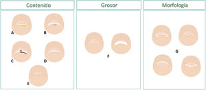 Esquema de las alteraciones en la visión frontal distal de la uña, en el hiponiquio y en la lámina ungueal. La respuesta del hiponiquio ante una alteración puede ser con hiperqueratosis (A), masas ocupantes de espacio (B), pigmentación (C) y/o hiperplasia (D). Los cambios en la lámina ungueal que nos podemos encontrar (D y E) son variaciones en el grosor (F) y en la morfología del borde distal de la uña (G).