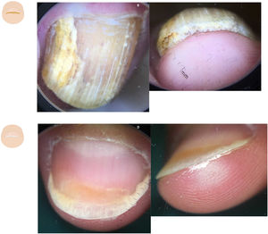 Alteraciones en el contenido. A. Dermatoscopia de onicomicosis en vista aérea; se observa onicolisis con un borde irregular, dermatofitoma y el signo de la aurora boreal. B. Dermatoscopia de onicomicosis en vista frontal distal con onicolisis, hiperqueratosis subungueal difusa y signo de la ruina. C. Dermatoscopia en psoriasis ungueal, con mancha en aceite y onicolisis. D. Dermatoscopia en psoriasis, que muestra onicolisis con hiperqueratosis subungueal difusa, fina y de color blanco plateado.