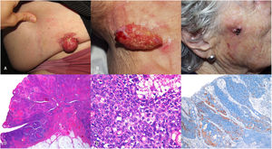 A-C) Imagen clínica de 3 pacientes. A) Lesión proliferativa, exofítica, eritematosa, friable y ulcerada de 5cm en hemiabdomen izquierdo. B) Lesión exofítica, pediculada, eritematosa, friable, y erosionada, de 4×2cm localizada en la cara lateral derecha cervical. C) Tumoración eritematosa, ulcerada, friable, de 2cm localizado en mejilla derecha. D-F) Imagen histopatológica. Hematoxilina eosina. Panorámica. Proliferación neoplásica exofítica con componente in situ asociado en el margen izquierdo (D). Hematoxilina eosina ×400. Áreas de carcinoma sebáceo in situ compuestas por sebocitos maduros e inmaduros (E). Tinción de inmunohistoquímica con adipofilina ×40. Inmunoexpresión para adipofilina en los sebocitos maduros (F).