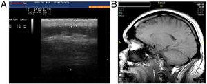 (A) Imagen ecográfica de la zona occipital con grosor del cuero cabelludo de 2,91cm, (B) la imagen de resonancia magnética muestra una diferencia importante entre el grosor del vértex y el del cuero cabelludo occipital.