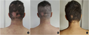 Presentación clínica basal (a) con mejora significativa de las lesiones de DA en la región cervical posterior y recrecimiento piloso en las zonas occipitales con AA en las semanas de terapia 4ª (b) y 12ª (c).