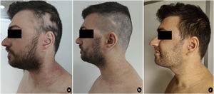 Presentación clínica basal (a) con mejora significativa de las lesiones de DA en la región cervical antero-lateral y recrecimiento piloso en las zonas parietotemporales izquierdas con AA en las semanas de terapia 4ª (b) y 12ª (c).