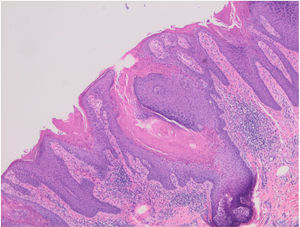 El examen histopatológico mostró una hiperplasia epidérmica psoriasiforme con varias columnas de paraqueratosis.