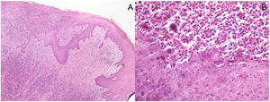 Imágenes histopatológicas: (A) Biopsia en sacabocados de una muestra de piel con ulceración superficial que muestra necrosis epidérmica subyacente a un denso infiltrado inflamatorio perivascular y perianexial superficial y profundo en la dermis. No se observan células malignas. (Hematoxilina/eosina ×40). (B) En mayor aumento se aprecian efectos citopáticos virales, como vacuolización de queratinocitos (ballooning), queratinocitos multinucleados con citoplasma eosinófilo, marginación de la cromatina nuclear e inclusiones intranuecleares eosinófilas (Cowdry tipo A). El infiltrado inflamatorio es predominantemente linfocítico, con células plasmáticas, neutrófilos y eosinófilos dispersos. (Hematoxilina/eosina ×400).