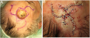 A: Case #1: Preoperative flap design. B: Case #1: Immediate postoperative results.