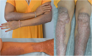 Patient's baseline health status showing well-demarcated brownish lichenified plaques with presence of excoriations in the distal extremities.