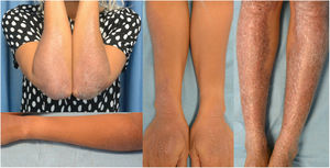 Seven months into dupilumab, the patient showed significant lesion improvement, especially on the upper limbs, with residual-looking thin plaques on both forearms. On the lower limbs, only thinner plaques with fewer excoriations remain.