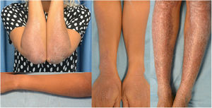 Seven months into dupilumab, the patient showed significant lesion improvement, especially on the upper limbs, with residual-looking thin plaques on both forearms. On the lower limbs, only thinner plaques with fewer excoriations remain.