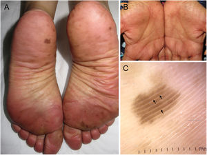 A) Brown pigmented macules with a lentiginous appearance distributed along the plantar surface of both feet added to the presence of erythema and mild edema, predominantly in both forefeet. B) Similar lesions, smaller in size and fewer in number, on both palms of the hands. C) Dermatoscopic image of a plantar lesion showing a parallel ridge pattern with spared acrosyringium (arrows).