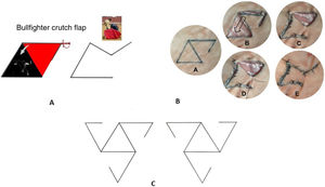a) Bullfighter crutch flap. b)A: Flap design. On an equilateral triangle, we draw the inverted triangular flap that shares one of the sides while the other side–the pedicle–only gets halfway there. B: Excision and dissection of the flap. C: The flap is rotated to close the primary surgical defect, thus creating a smaller secondary defect. D: Angle point to close the secondary surgical defect. E: Final closure. c) The flap has 6 different design options to choose from to best suit the perioral surgical defect.