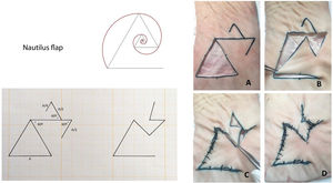 Nautilus flap: on the same design pattern of the bullfighter crutch flap, an additional upper triangle is drawn, whose sides measure half of the initial flap. This new triangle will be rotated in the opposite direction to close the secondary defect. A: Flap design on a triangular defect. B: Rotation of the flap to close the primary surgical defect. C: Closure of the secondary defect by rotating the upper triangle. E: Final closure.