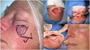 Design, performance, and postoperative outcomes of the nautilus flap on a left subpalpebral lesion, along with a simple spindle design for another smaller lesion medial to it. A: Flap design. B: Lesion excision creating a triangular surgical defect. C: Rotation of the 2 triangular flaps in opposite directions. D: Final suturing of the flaps. E: Final outcomes at the 3-month follow-up.