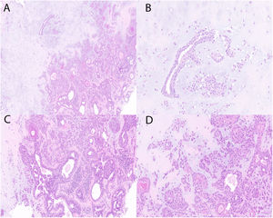 A: Hematoxylin-eosin (x5). B, C, D: Hematoxylin-eosin (x20).