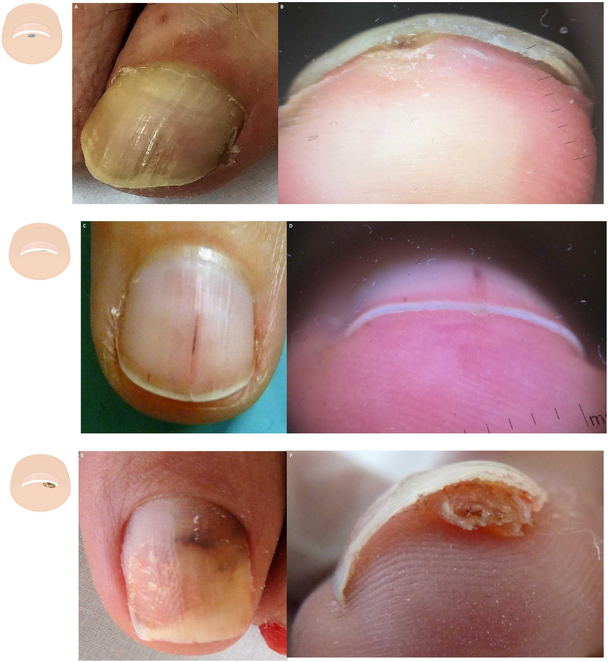 Onychoscopy: an observational study in 237 patients from the Kashmir Valley  of North India | Dermatology Practical & Conceptual