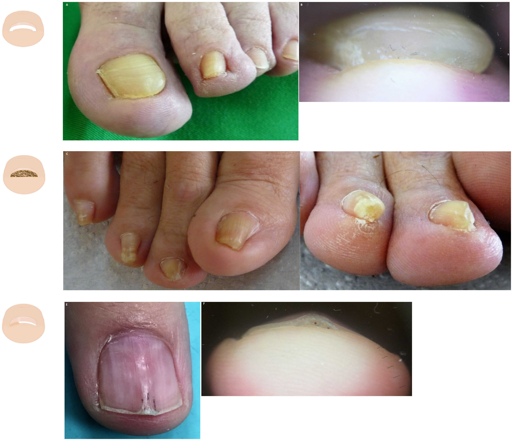 Nail lichen planus: a patient with atypical presentation