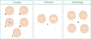 Scheme of changes to the nail distal frontal view, hyponychium, and nail plate. The hyponychium response to a change can be with hyperkeratosis (A), space-occupying masses (B), pigmentation (C), and/or hyperplasia (D). Variations in thickness (F) and morphology of the nail distal edge (G) are some of the changes to the nail plate we can find (D and E).