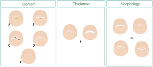 Scheme of changes to the nail distal frontal view, hyponychium, and nail plate. The hyponychium response to a change can be with hyperkeratosis (A), space-occupying masses (B), pigmentation (C), and/or hyperplasia (D). Variations in thickness (F) and morphology of the nail distal edge (G) are some of the changes to the nail plate we can find (D and E).
