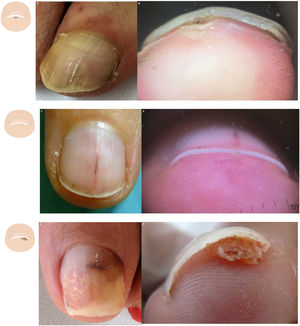 Content changes. A: Onychoclavus: onycholysis with pigmented spot in the nail middle distal region. B: Onychoclavus: hyperkeratosis with a hemorrhagic area in the hyponychium middle section. C: Onychopapilloma: discreet longitudinal erythronychia with splinter hemorrhage and mild distal “V” onycholysis. D: Onychopapilloma: onycholysis with focal subungual hyperkeratosis attached to the nail plate ventral region. F: Fibrokeratoma: lateral onycholysis with a hemorrhagic pigmented area. G: Fibrokeratoma: onycholysis with presence of well-demarcated subungual hyperkeratosis.