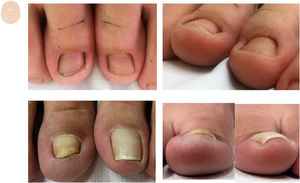 Content changes. A: Aerial view of a child's first toes. B: Hypertrophy of the distal nail fold. C: Aerial view of an adult's first toes, with a reduced nail length. D: Hypertrophy of the distal nail fold and angle loss of the transverse axis of the nail free edge.