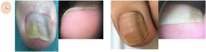 Content changes. A: Aerial view of longitudinal melanonychia. B: Pigmentation affecting the nail plate ventral region. C: Aerial view of longitudinal melanonychia. D: Pigmentation affecting the nail plate dorsal region.