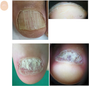 Thickness changes. A: Aerial view of onychorrhexis, longitudinal grooves across the entire nail plate surface. B: Irregular loss of nail plate thickness. C: Aerial view of psoriasis, total nail dystrophy. D: Hapalonychia, thinning of the nail plate.