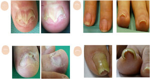 Thickness changes. A: Aerial view of lichen planus: onycholysis with nail plate loss. B: Lichen planus: tent sign. C: Aerial view of idiopathic onycholysis with a smooth proximal border on the fingers. D: The degree of onycholysis can be better seen in the frontal view. E: Aerial view of nail lichen planus, with a central fissure and hapalonychia. F: Lateral view shows koilonychia, with a concave transverse axis. G: Aerial view of the first toe nail with narrowing of the transverse axis in the nail middle distal region. H: Type 1 or common pincer nail, with an increased angle of the nail distal transverse axis.