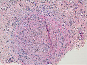 Biopsia de lesión nodular en pierna, objetivándose vasculitis de vaso de mediano calibre y oclusión vascular con recanalización. Hematoxilina-eosina, ×100.