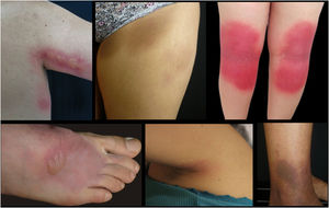 Aspecto clínico de las lesiones clínicas en los diferentes casos. Localizaciones anatómicas más frecuentes.