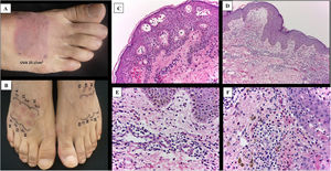 A) Prueba de fotoprovocación positiva. B) Comparación de la DEM en piel comprometida y no comprometida, dosis en mJ/cm2. C-F) Aspecto histopatológico de las lesiones. C) Formación de vesículas intraepidérmicas con células apoptósicas (H&E, ×10). D) Epidermis con presencia de células apoptósicas, edema en dermis superior e infiltrado perivascular de tendencia liquenoide. E y F) Infiltrado en la dermis superior de predominio linfocitario con eosinófilos entremezclados e incontinencia del pigmento melánico (H&E, ×40).