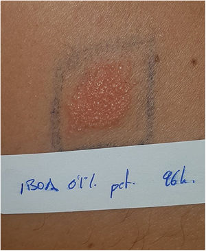 Prueba del parche positiva las 96h a IBOA en paciente con dermatitis de contacto al sensor FreeStyle Libre®.