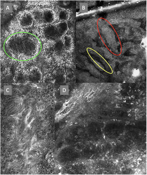 Imágenes de microscopia confocal de la unión dermoepidérmica. Izquierda superior (A). Se observa un patrón en anillos y empedrado, con papilas mal definidas y células dendríticas que protruyen en la papila y llegan a configurar la estructura tipo mitocondria (círculo verde). Derecha superior (B) se observan engrosamientos junturales (rojo) y papilas elongadas (amarillo). Izquierda inferior (C) se observa pérdida de la arquitectura normal de la unión dermoepidérmica. Derecha inferior (D), a mayor aumento, se observan papilas mal delimitadas, con células atípicas (dendríticas y redondas).