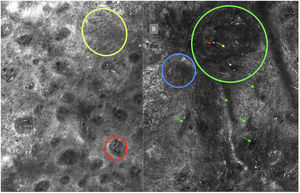 A la izquierda (A) observamos un desorden arquitectural epidérmico con presencia de vasos en botón, uno de ellos indicado en círculo rojo, así como un patrón en panal de abejas atípico (círculo amarillo), imagen característica de enfermedad de Bowen. A la derecha (B) se observa polarización de núcleos (círculo azul), vasos horizontalizados (flechas verdes), nidos basaloides (círculo verde), hendidura (flecha roja) y empalizada periférica (flecha amarilla) hallazgos característicos en un carcinoma basocelular.