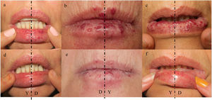 Hereditary haemorrhagic telangiectasia. Patient treated each body side with DWSL laser (D) and Nd:YAG laser (Y), respectively. (A) Pre-treatment clinical photograph (above, a–c), (B) post-treatment clinical photograph (below, d–f), after 4 sessions.