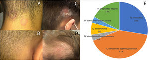 A) Formas no inflamatorias que remedan dermatitis seborreica. B) Tiña de puntos negros (black dots). C) Forma inflamatoria con adenopatía retroauricular. D) Tinea capitis simulando costra láctea. E) Descripción de la casuística diagnosticada en el centro.