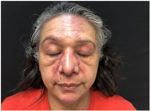Facial and heliotrope rash before pulsed dye laser therapy.