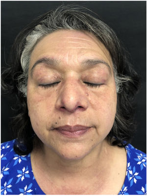 Therapeutic response after treatment.