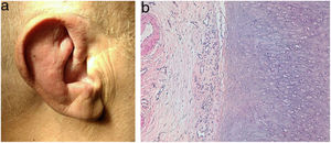 A: Erythema and edema of the pinnae. B: Auricular cartilage biopsy with degenerated cartilage and chronic inflammation in the perichondrium. Hematoxylin-eosin, ×100.