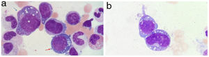 A: Vacuolization of the nucleus and cytoplasm of myeloid (blue arrow) and erythroid (red arrow) precursors in the bone marrow aspirate. May-Grunwald-Giemsa, ×100. B: Vacuolization of the nucleus and cytoplasm of myeloid precursors in bone marrow aspirate. May-Grunwald-Giemsa, ×100.