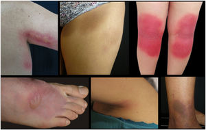 Clinical appearance of clinical lesions in different cases. Most commom anatomical sites.