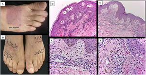 A) Positive photoprovocation test. B) Comparison of MED in affected and unaffected skin, dose in mJ/cm2. C-F) Histopathological appearance of the lesions. C) Formation of intraepidermal vesicles with apoptotic cells (H&E, ×10). D) Epidermis with presence of apoptotic cells, upper dermis edema, along with perivascular lichenoid-like infiltrate. E and F) Infiltrate in the upper dermis with predominant lymphocytes and interspersed eosinophils and incontinence of melanin pigment (H&E, ×40).