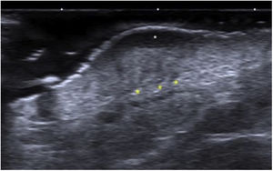 Ultrasound findings of DFSP: Grayscale ultrasound, longitudinal view showing the classic image of a DFSP with an oval mass, poorly defined borders, and a hypoechoic band in the dermis and hypodermis (white arrow). At the base, the lesion is hyperechoic with adjacent borders and pseudopod projections (yellow markers).