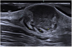 Ultrasound findings of DFSP: Grayscale ultrasound, axial image showing a poorly defined mass (yellow markers) with classic pseudopod projections.
