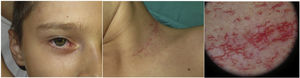Main clinical and dermatoscopic findings in A-T.