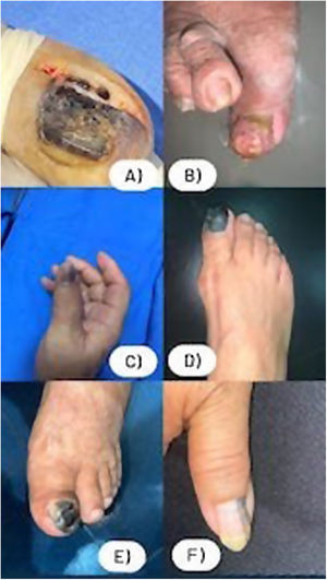 Clinical features of subungual melanomas. A) Nail dystrophy with Hutchinson's sign affecting the proximal, left lateral, and distal fold of the right hallux. B) Amelanotic nodular growth on the right hallux. C) 1st finger of the right hand with Hutchinson's sign affecting the entire nail apparatus. D) Right hallux with Hutchinson's sign affecting the entire nail apparatus. E) Left hallux with nodular growth, Hutchinson's sign, and involvement of the proximal, left lateral, and distal fold. F) Longitudinal melanonychia on the right hand 1st finger.